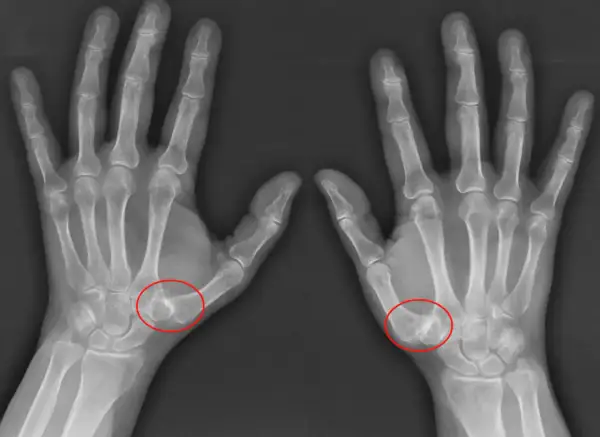 Radiografías de ambas manos mostrando rizartrosis grados avanzados en la base del pulgar, con deformidad ósea y estrechamiento articular.