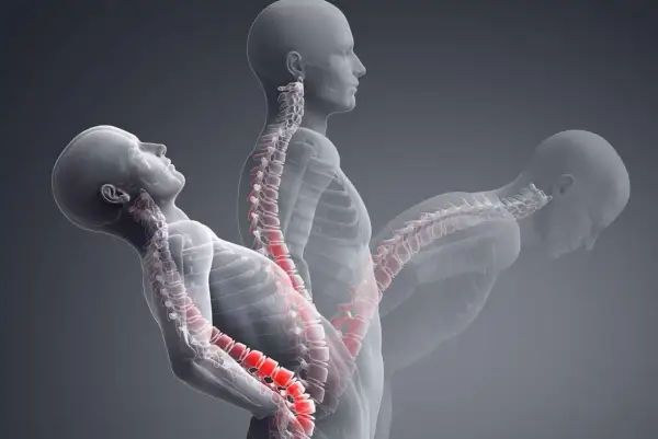 Ilustración de la columna vertebral humana en tres posturas, mostrando la tensión en las articulaciones interapofisarias.