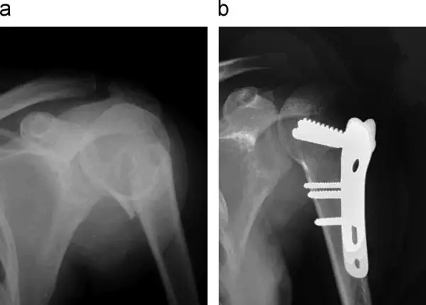 Radiografía muestra fractura humero proximal antes y después de la cirugía con placa y tornillos.