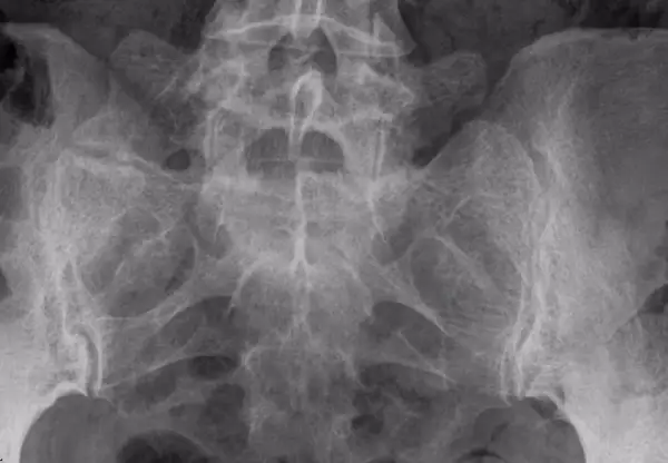 Radiografía de pelvis y columna lumbar. Se observan cambios degenerativos y esclerosis en la apófisis transversa.