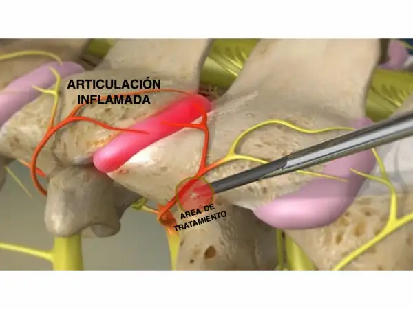 Ilustración de articulación interapofisaria inflamada y su tratamiento.
