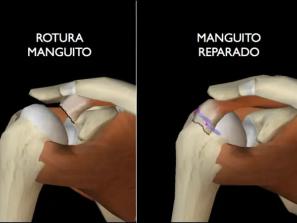 Comparación de un manguito rotador roto con uno reparado, mostrando cómo el manguito rotador se cura solo.