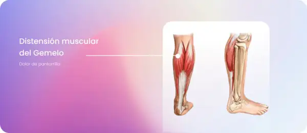 Ilustración anatómica de la pantorrilla, mostrando la distensión muscular del gemelo y el dolor asociado en la pierna.