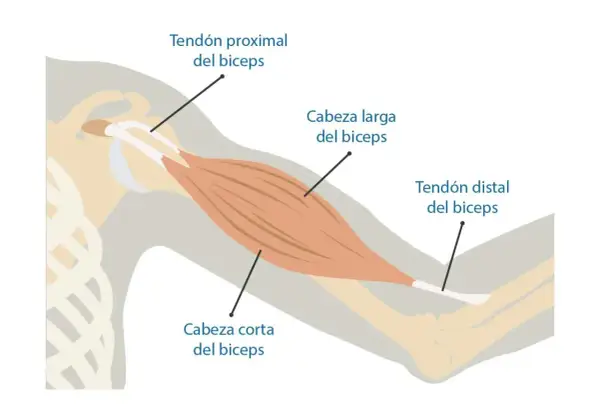 Anatomía del bíceps, mostrando tendón proximal, cabeza larga y corta, y tendón distal. Ilustra la zona donde puede ocurrir una rotura de bíceps.