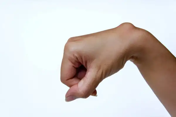 Mano con un bulto visible en la muñeca, indicativo de un ganglio muñeca operacion.