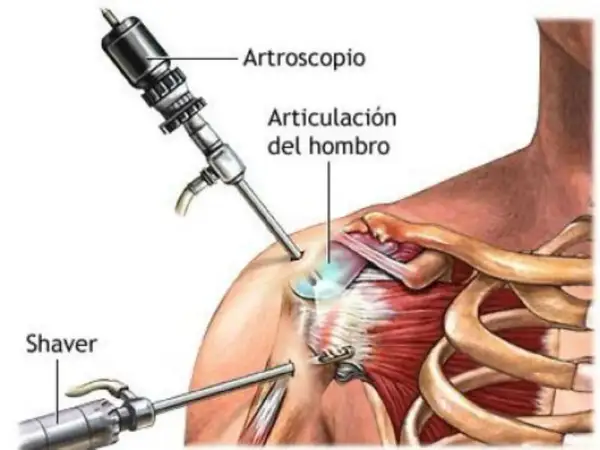 Ilustración de artroscopia de hombro para tratar una luxación glenohumeral. Se ven un artroscopio y un shaver.