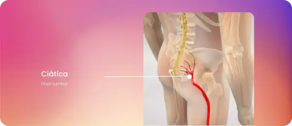 Ilustración de ciática, mostrando dolor lumbar derecho irradiado hacia adelante a lo largo del nervio ciático.