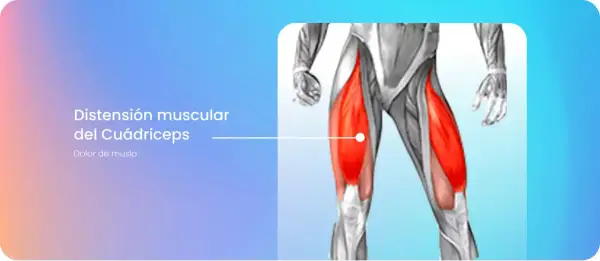 Anatomía del cuádriceps con el vasto interno inflamado, indicando dolor de muslo.