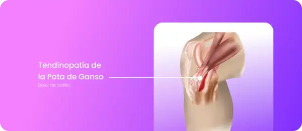 Ilustración de la tendinopatía de la pata de ganso en la rodilla, mostrando la inflamación y el dolor. La recuperación es clave.